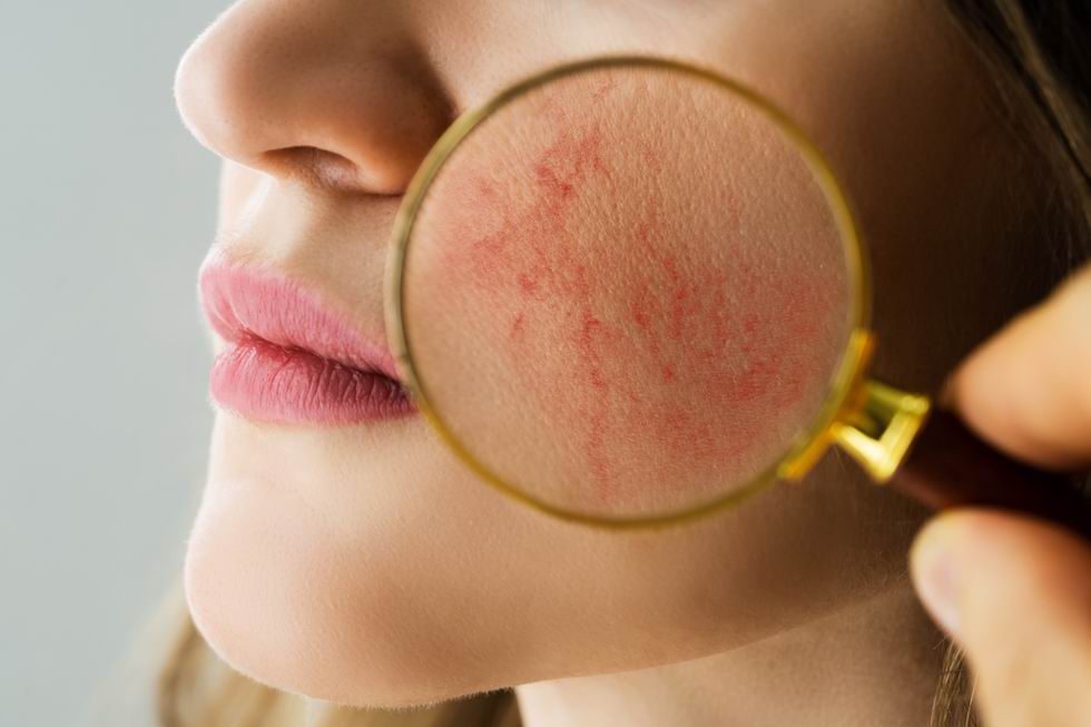 rosacea kezelés